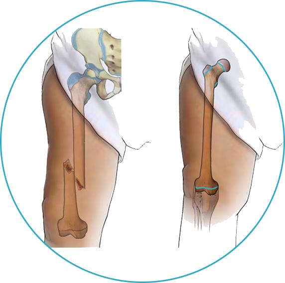 Femore rotto Margaret Mead